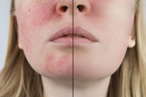 Hypoallergene make-up bij rosacea: zo kies je - Mineralissima